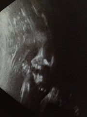 25 weeks ultrasound scan.